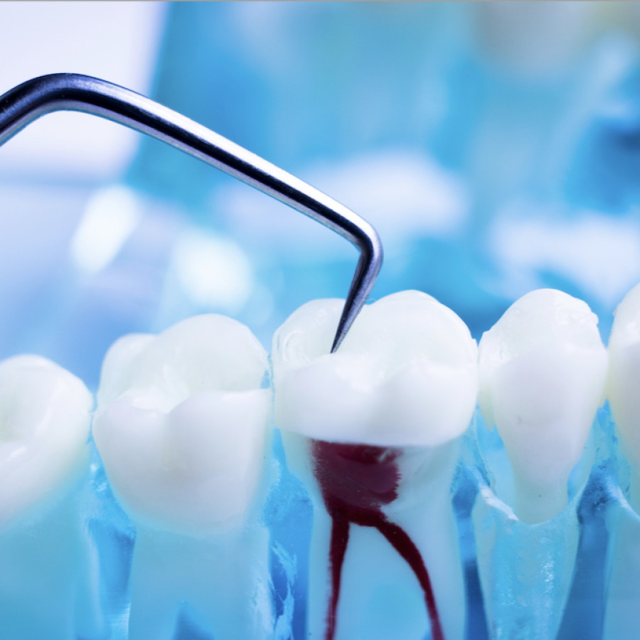 Endodoncia: el último recurso para salvar un diente