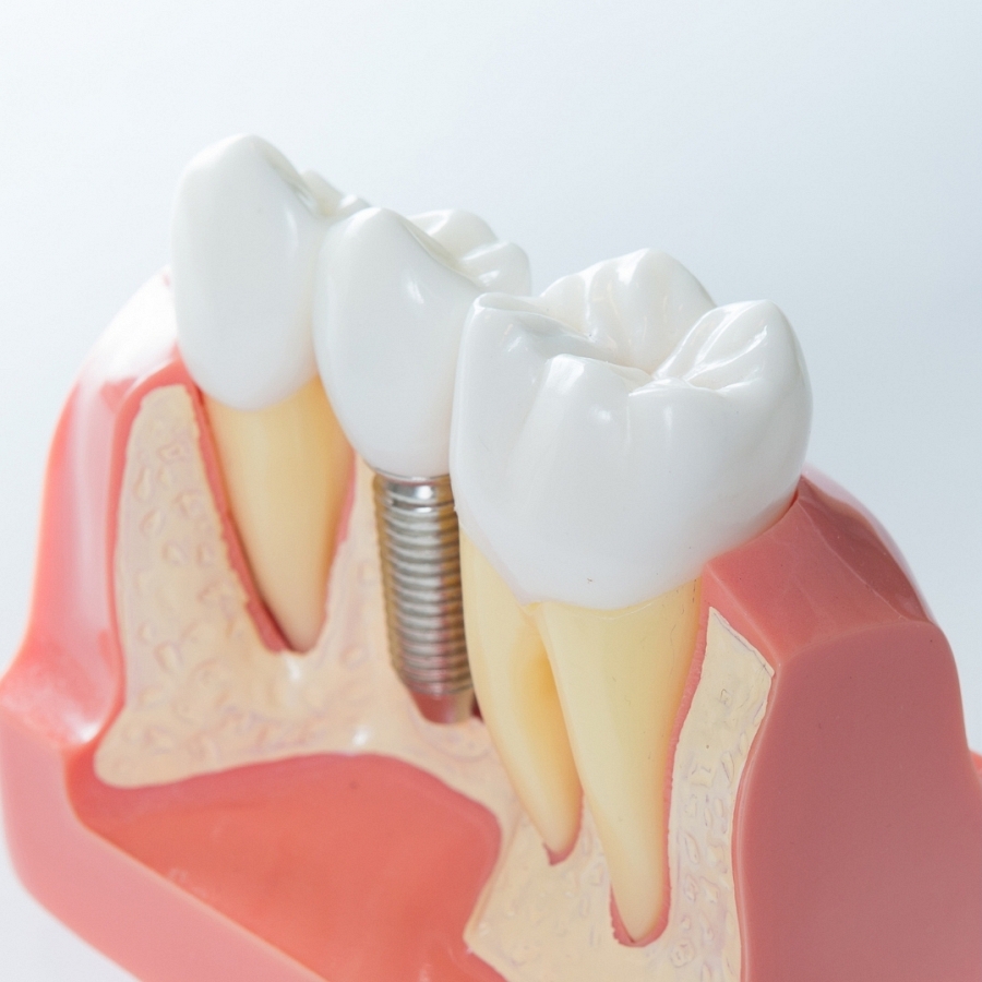Problemas derivados de la pérdida de dientes y alternativas de tratamiento.