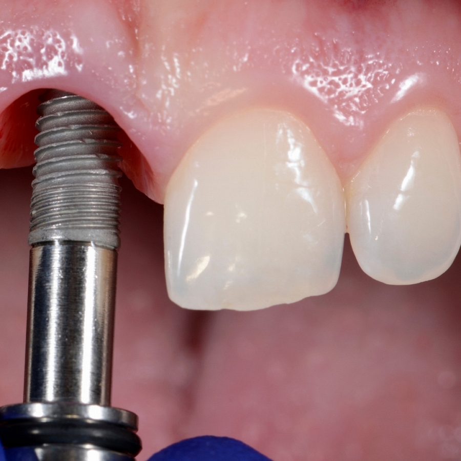 Recupera tus dientes en un día con los implantes de carga inmediata