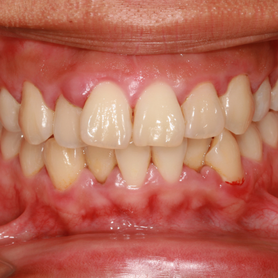 Tipos de enfermedades periodontales: gingivitis y periodontitis
